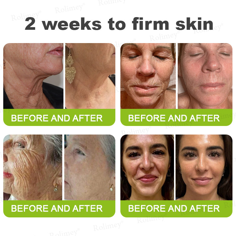 💎Made and shipped from Australia  Rolimey® Botox & Vita-A Retinol Shot Wrinkle-Lift Tightening cream - Last Day Promotion 70% OFF|