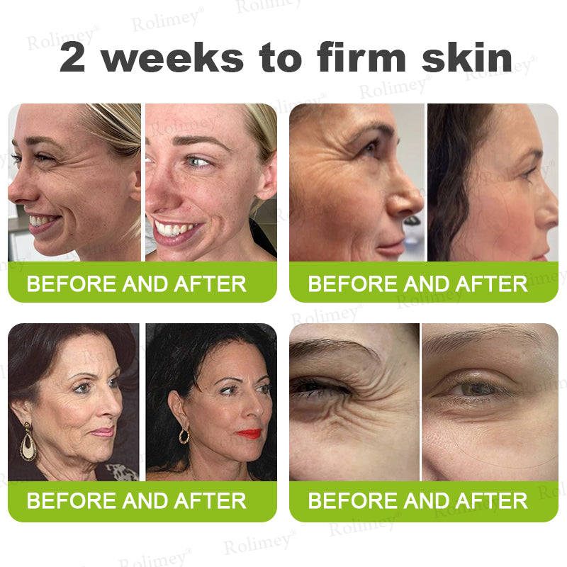 💎Made and shipped from Australia  Rolimey® Botox & Vita-A Retinol Shot Wrinkle-Lift Tightening cream - Last Day Promotion 70% OFF|