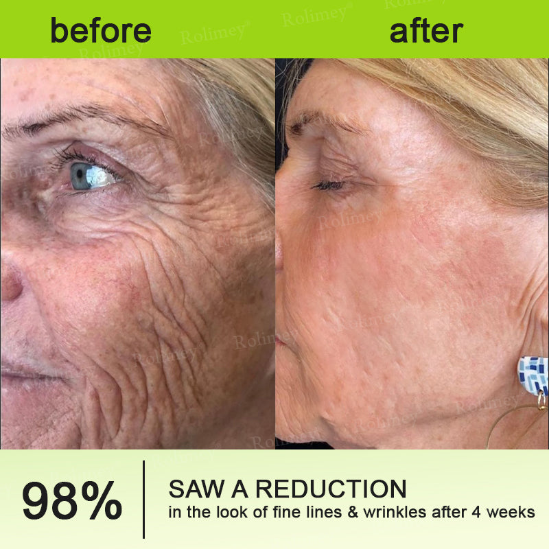 💎Made and shipped from Australia  Rolimey® Botox & Vita-A Retinol Shot Wrinkle-Lift Tightening cream - Last Day Promotion 70% OFF|