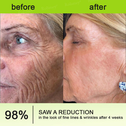 💎Made and shipped from Australia  Rolimey® Botox & Vita-A Retinol Shot Wrinkle-Lift Tightening cream - Last Day Promotion 70% OFF|